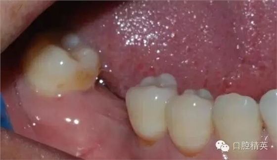 后牙烤瓷橋備牙全過程 后牙烤瓷橋備牙全過程