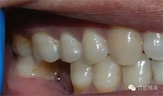 后牙烤瓷橋備牙全過程 后牙烤瓷橋備牙全過程