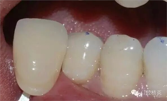 后牙烤瓷橋備牙全過程 后牙烤瓷橋備牙全過程