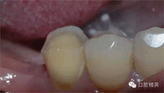 后牙烤瓷橋備牙全過程 后牙烤瓷橋備牙全過程