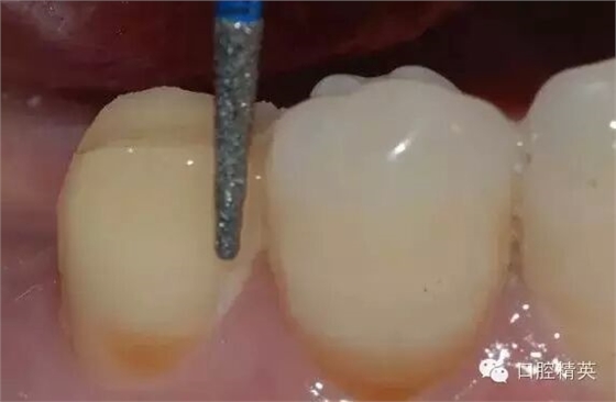后牙烤瓷橋備牙全過程 后牙烤瓷橋備牙全過程