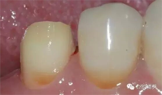 后牙烤瓷橋備牙全過程 后牙烤瓷橋備牙全過程