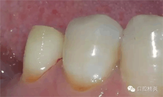 后牙烤瓷橋備牙全過程 后牙烤瓷橋備牙全過程