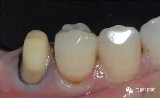 后牙烤瓷橋備牙全過程 后牙烤瓷橋備牙全過程