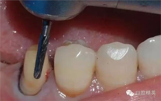 后牙烤瓷橋備牙全過程 后牙烤瓷橋備牙全過程