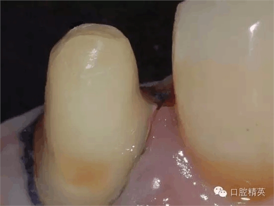 后牙烤瓷橋備牙全過程 后牙烤瓷橋備牙全過程