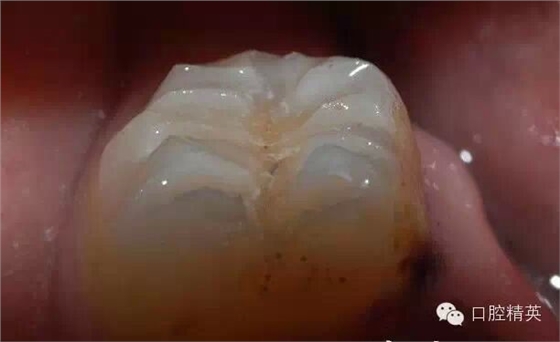 后牙烤瓷橋備牙全過程 后牙烤瓷橋備牙全過程