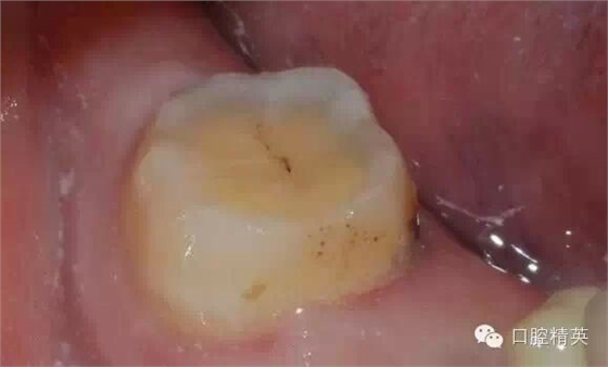 后牙烤瓷橋備牙全過程 后牙烤瓷橋備牙全過程