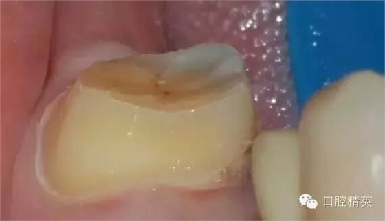 后牙烤瓷橋備牙全過程 后牙烤瓷橋備牙全過程