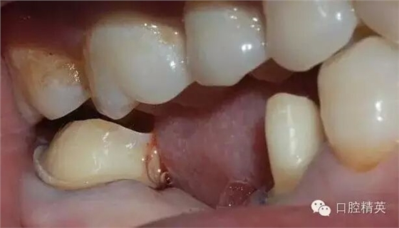 后牙烤瓷橋備牙全過程 后牙烤瓷橋備牙全過程