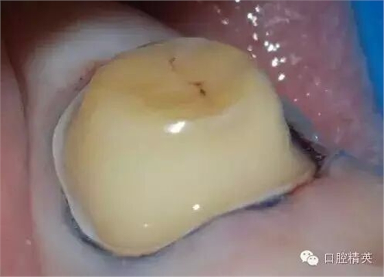 后牙烤瓷橋備牙全過程 后牙烤瓷橋備牙全過程