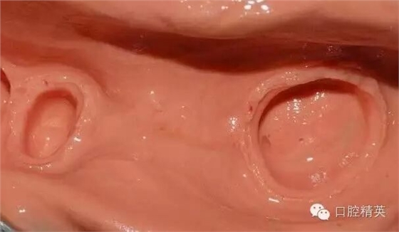 后牙烤瓷橋備牙全過程 后牙烤瓷橋備牙全過程