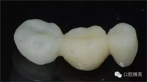 后牙烤瓷橋備牙全過程 后牙烤瓷橋備牙全過程