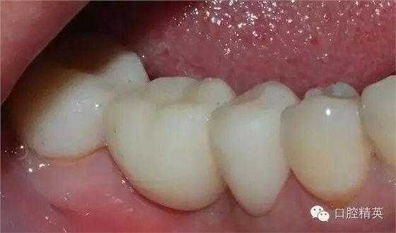 后牙烤瓷橋備牙全過程 后牙烤瓷橋備牙全過程