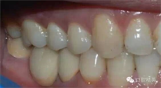 后牙烤瓷橋備牙全過程 后牙烤瓷橋備牙全過程