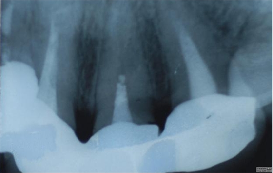 認(rèn)真看待根管治療在醫(yī)院診所技術(shù)中的地位 認(rèn)真看待根管治療在醫(yī)院診所技術(shù)中的地位