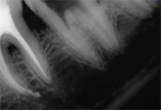 牙醫(yī)的“癢癢”—— 斷針 牙醫(yī)的“癢癢”—— 斷針