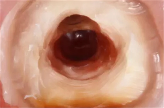 根管側(cè)穿修補(bǔ)方法 根管側(cè)穿修補(bǔ)方法