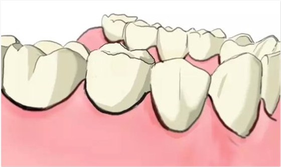 種植【最全的種植牙介紹】 種植【最全的種植牙介紹】