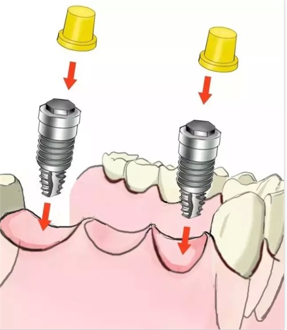 種植【最全的種植牙介紹】 種植【最全的種植牙介紹】