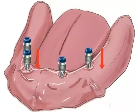 Q種植【最全的種植牙介紹】 Q種植【最全的種植牙介紹】