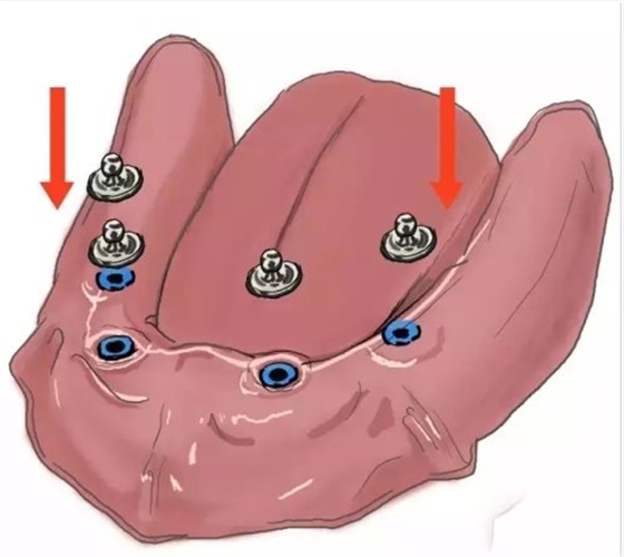 種植【最全的種植牙介紹】 種植【最全的種植牙介紹】