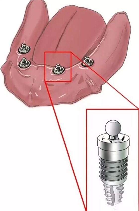 種植【最全的種植牙介紹】 種植【最全的種植牙介紹】