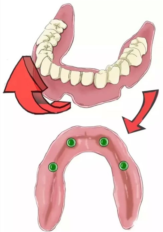種植【最全的種植牙介紹】 種植【最全的種植牙介紹】