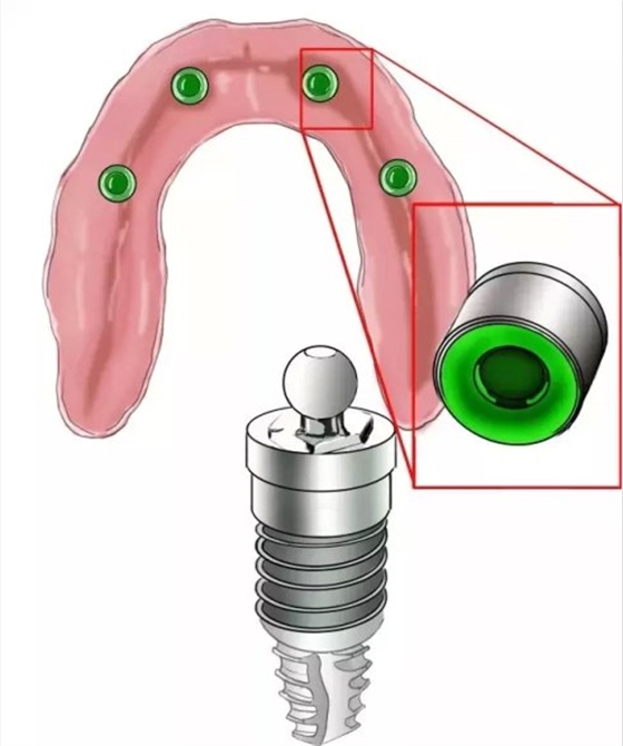 種植【最全的種植牙介紹】 種植【最全的種植牙介紹】