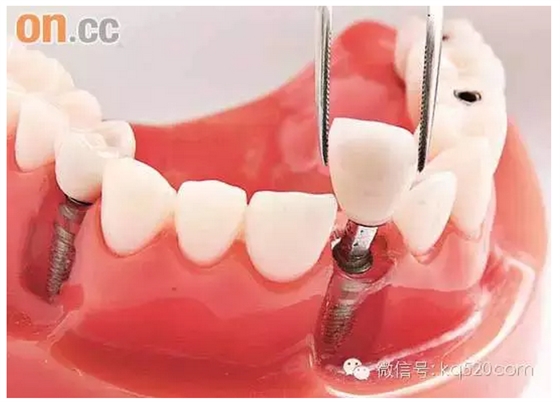有關(guān)種植牙的一些常見問題問答 有關(guān)種植牙的一些常見問題問答