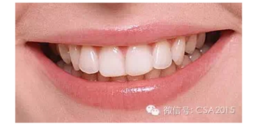 “蝴蝶效應(yīng)”:牙齒不齊引起的連鎖反應(yīng) “蝴蝶效應(yīng)”:牙齒不齊引起的連鎖反應(yīng)