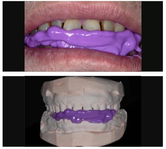 瓷貼面實戰(zhàn)流程 瓷貼面實戰(zhàn)流程