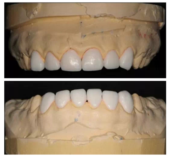 瓷貼面實戰(zhàn)流程 瓷貼面實戰(zhàn)流程