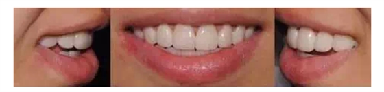 瓷貼面實戰(zhàn)流程 瓷貼面實戰(zhàn)流程