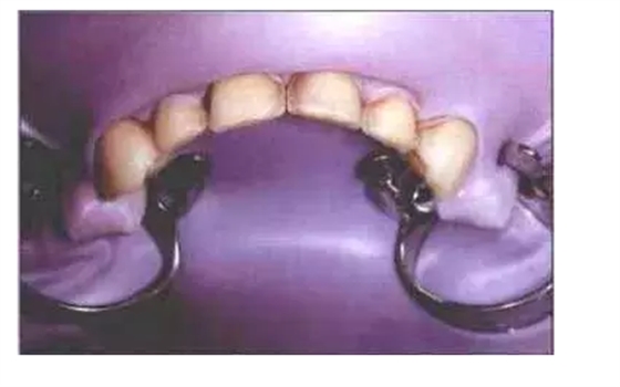 瓷貼面實戰(zhàn)流程 瓷貼面實戰(zhàn)流程