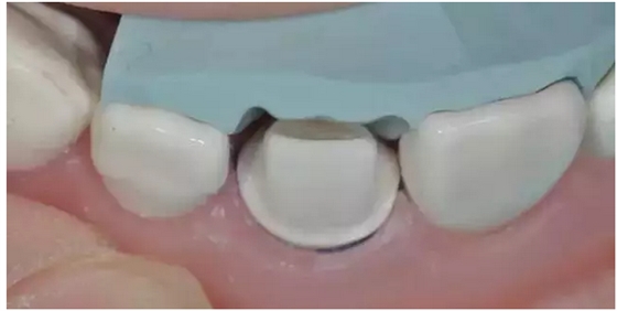 為什么你的牙齒備不好 為什么你的牙齒備不好