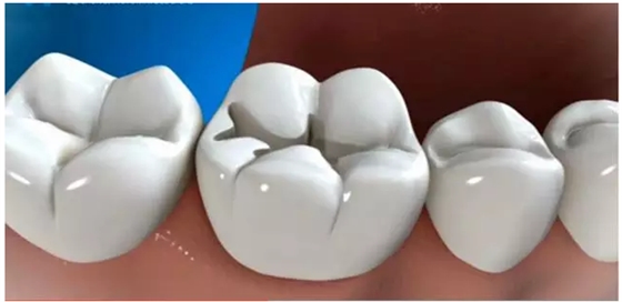 補(bǔ)牙全過程 補(bǔ)牙全過程