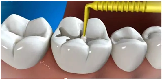 補(bǔ)牙全過程 補(bǔ)牙全過程