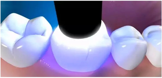 補(bǔ)牙全過程 補(bǔ)牙全過程