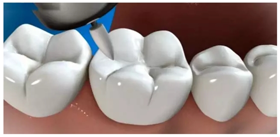 補(bǔ)牙全過程 補(bǔ)牙全過程