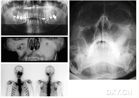 頜骨纖維性結構不良癥