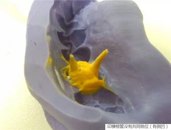 氧化鋯樁核后牙根管有倒凹設(shè)計(jì) 氧化鋯樁核后牙根管有倒凹設(shè)計(jì)