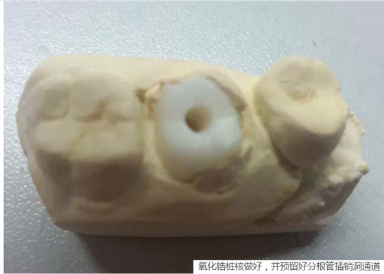 氧化鋯樁核后牙根管有倒凹設(shè)計(jì) 氧化鋯樁核后牙根管有倒凹設(shè)計(jì)