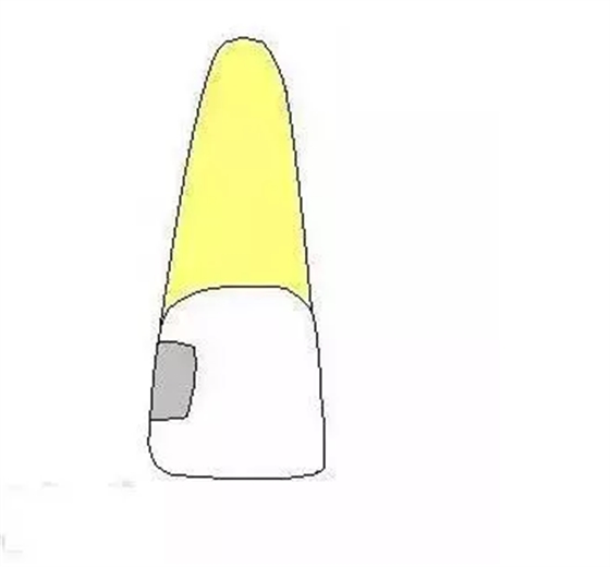 齲齒齲洞的5種類型 齲齒齲洞的5種類型