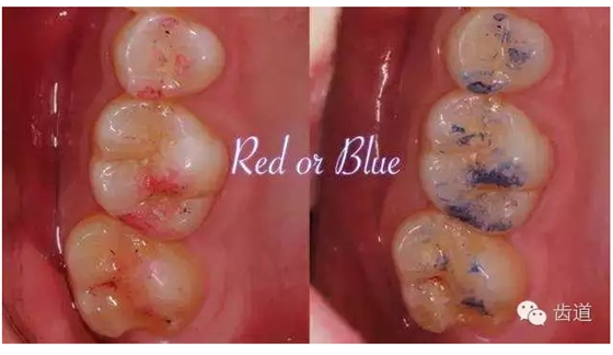 牙科咬合紙的用法 牙科咬合紙的用法