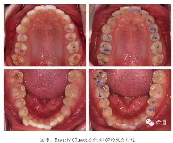 牙科咬合紙的用法 牙科咬合紙的用法