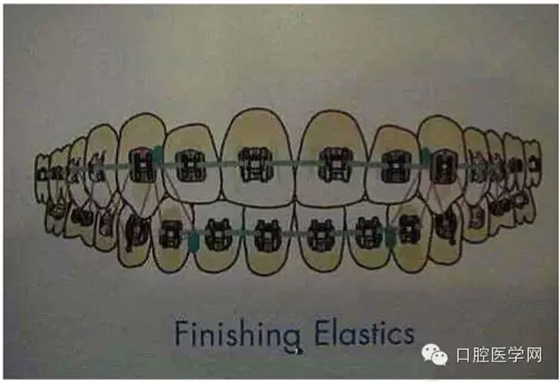 正畸damon system橡皮筋(elastics)掛法示意圖 正畸damon system橡皮筋(elastics)掛法示意圖