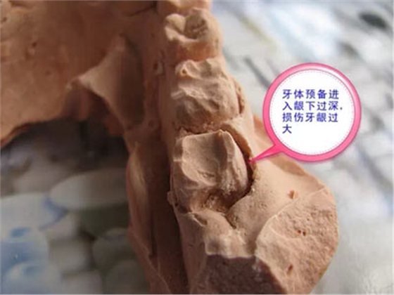 備牙應(yīng)注意的事項(xiàng)+備牙取摸損傷牙齦問題 備牙應(yīng)注意的事項(xiàng)+備牙取摸損傷牙齦問題