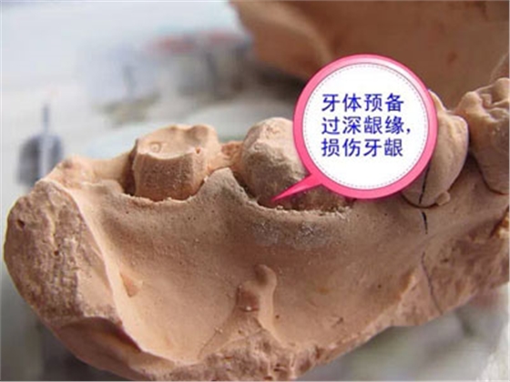 備牙應(yīng)注意的事項(xiàng)+備牙取摸損傷牙齦問題 備牙應(yīng)注意的事項(xiàng)+備牙取摸損傷牙齦問題