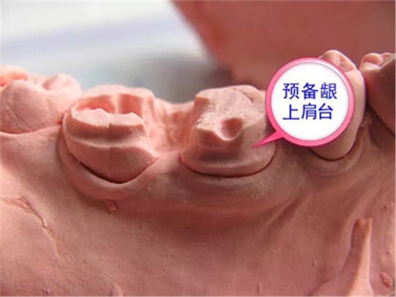 備牙應(yīng)注意的事項(xiàng)+備牙取摸損傷牙齦問題 備牙應(yīng)注意的事項(xiàng)+備牙取摸損傷牙齦問題